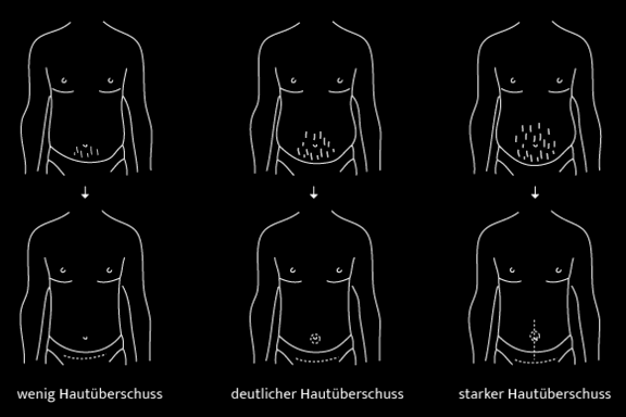 grafik-bauchdeckenstraffung-plastische-chirurgie-central-aesthetics-frankfurt-dr-deb.png 