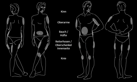 Grafik Fettabsaugung, Dr. Deb, Central Aesthetics, Plastische Chirurgie & Schönheitschirurgie in Frankfurt