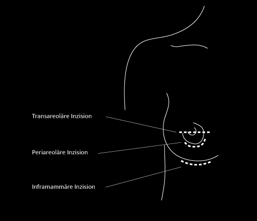 Grafik Brustvergrößerung, Dr. Deb, Central Aesthetics, Plastische Chirurgie & Schönheitschirurgie in Frankfurt