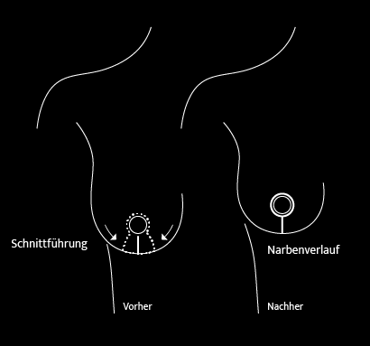 Grafik Brustverkleinerung, Dr. Deb, Central Aesthetics, Plastische Chirurgie & Schönheitschirurgie in Frankfurt