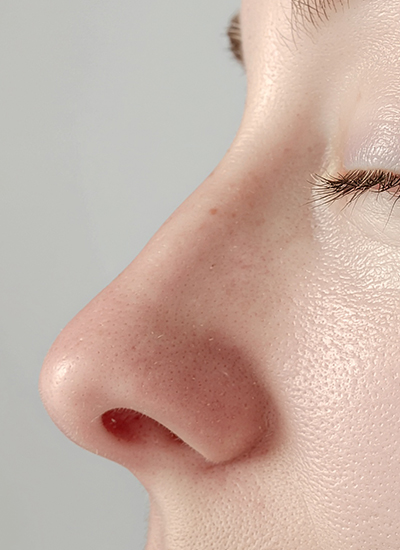 Nasenkorrektur, Dr. Deb, Central Aesthetics, Plastische Chirurgie & Schönheitschirurgie in Frankfurt