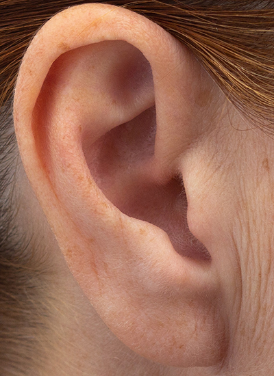 Ohrenkorrektur, Dr. Deb, Central Aesthetics, Plastische Chirurgie & Schönheitschirurgie in Frankfurt