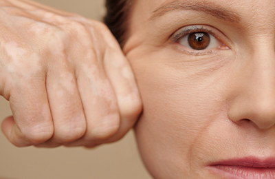 Facelift in Frankfurt, Central Aesthetics