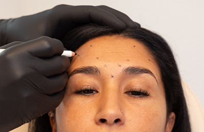 Faltenbehandlung BTX in Frankfurt, Central Aesthetics