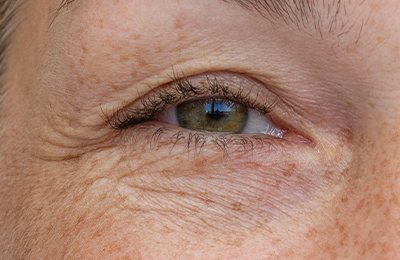 Unterlidstraffung in Frankfurt, Central Aesthetics