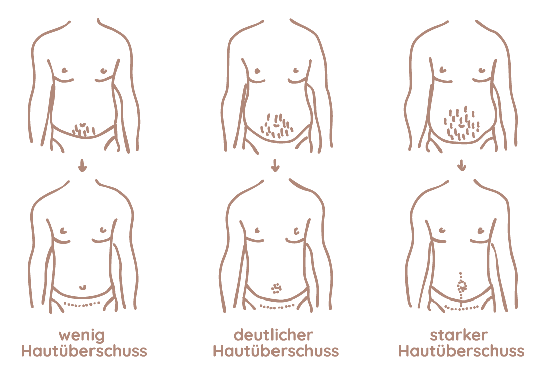 Bauchdeckenstraffung Grafik Frankfurt