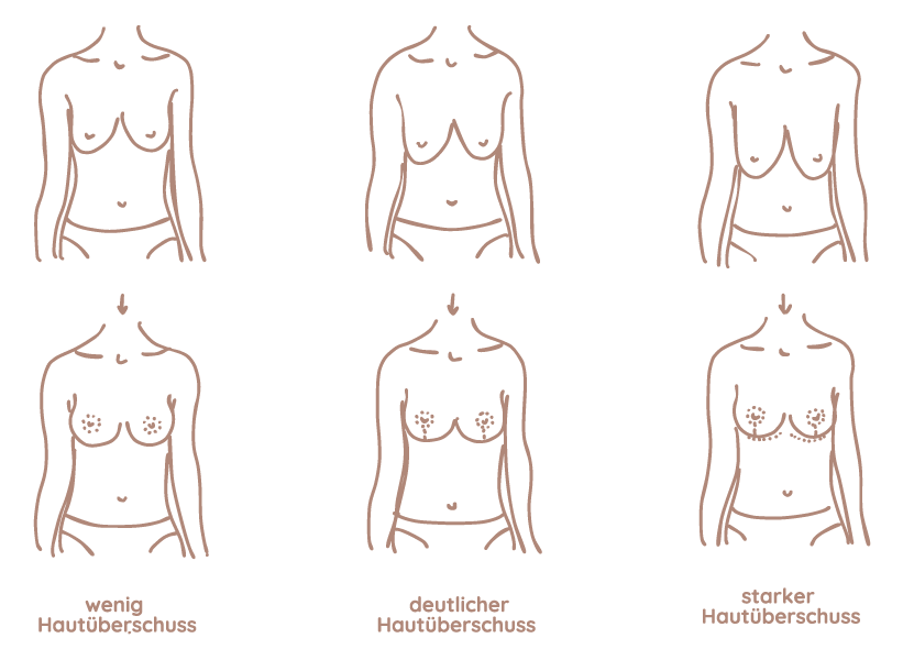 Bruststraffung Grafik Frankfurt