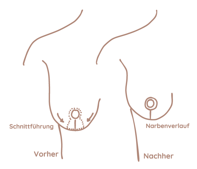 Brustverkleinerung Grafik Frankfurt