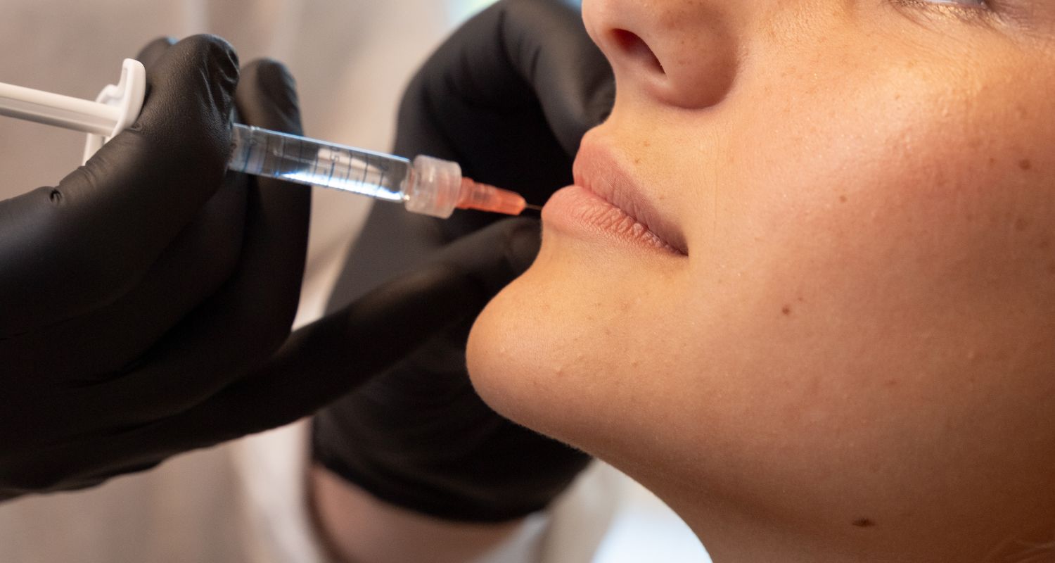 Lippen Aufbau bei Central Aesthetics in Frankfurt