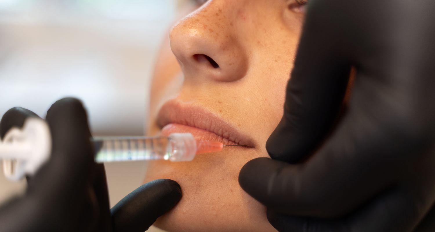 Lippen Aufspritzen bei Central Aesthetics in Frankfurt