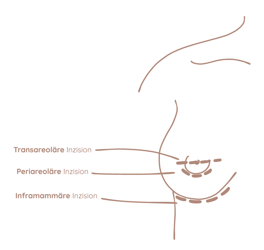 Schnittführung Narben Brustvergrößerung