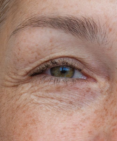 Oberlidstraffung Zeitpunkt