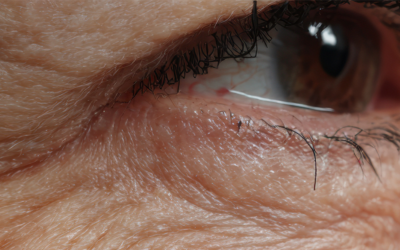 Wann ist der richtige Zeitpunkt für eine Oberlidstraffung?