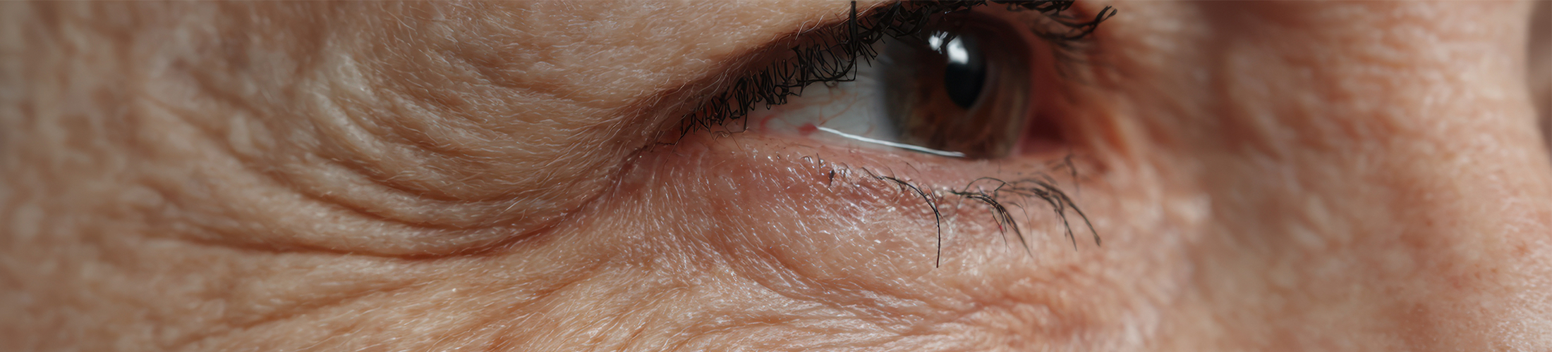 Wann ist der richtige Zeitpunkt für eine Oberlidstraffung?